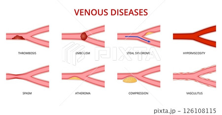Human vein disease, venous disorders vector set. Thrombosis, embolism, steal syndrome, hyperviscosity, spasm, atheroma, compression and vasculitis. Health care or educational and medical infographics Human vein disease, venous disorders vector set. Thrombosis, embolism, steal syndrome, hyperviscosity, spasm, atheroma, compression and vasculitis. Health care or educational and medical infographics 126108115