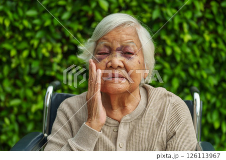 senior woman injury to eyelid and nose swelling from an accident senior woman injury to eyelid and nose swelling from an accident 126113967