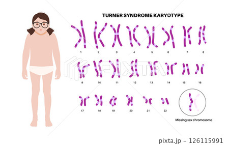 Turner syndrome poster 126115991