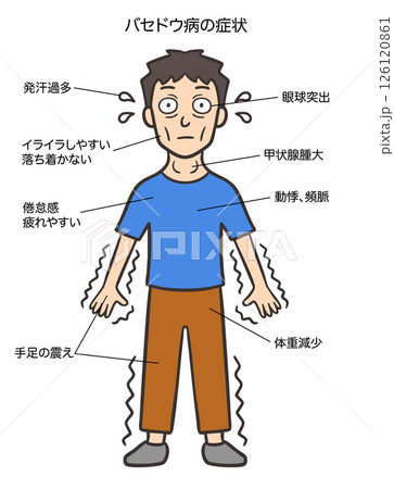 バセドウ病のサイン、特徴的な症状、男性 バセドウ病のサイン、特徴的な症状、男性 126120861