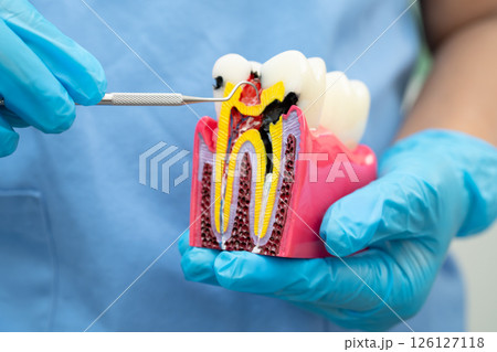 Teeth root dental model with tool for dentist use to cleaning care treatment. Teeth root dental model with tool for dentist use to cleaning care treatment. 126127118