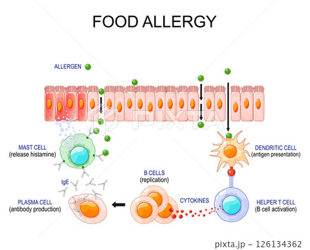 Food allergy. Process of allergic reaction and immune response Food allergy. Process of allergic reaction and immune response 126134362