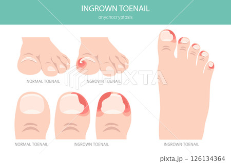 Ingrown Toenail (Onychocryptosis). Medical Infographic Vector Illustration 126134364