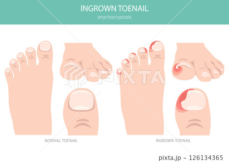 Ingrown Toenail (Onychocryptosis). Medical Infographic Vector Illustration 126134365