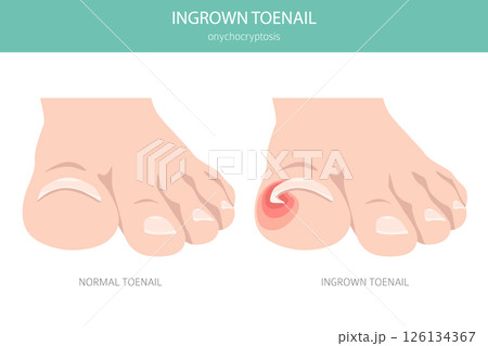 Ingrown Toenail (Onychocryptosis). Medical Infographic Vector Illustration 126134367