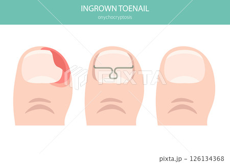 Ingrown Toenail (Onychocryptosis). Medical Infographic Vector Illustration 126134368