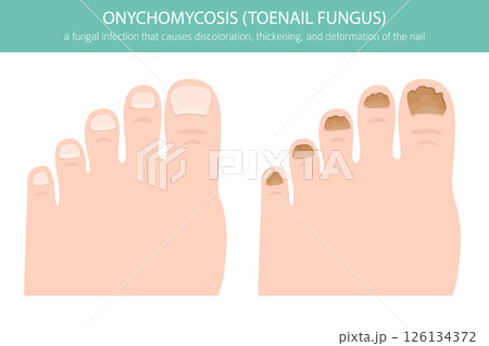 Onychomycosis Toenail Fungal Infection Vector Illustration 126134372