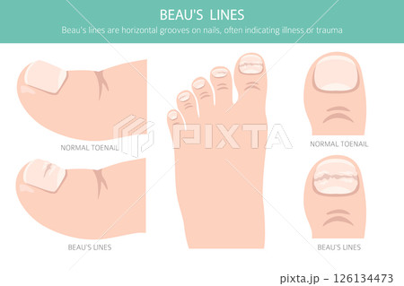 Beau's Lines. Medical Nail Disorder 126134473