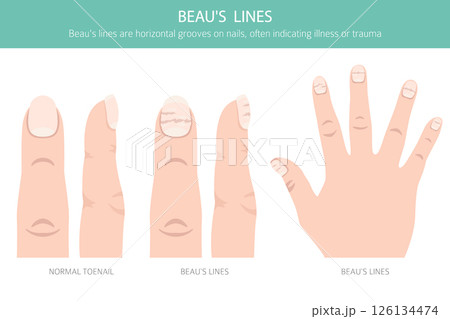 Beau's Lines. Medical Nail Disorder Beau's Lines. Medical Nail Disorder 126134474