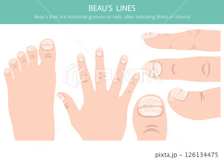 Beau's Lines. Medical Nail Disorder 126134475