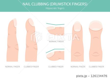Digital Clubbing Nail Disease - Medical Infographic Vector Illustration 126134476