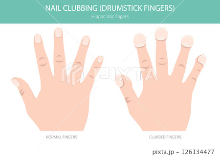 Digital Clubbing Nail Disease - Medical Infographic Vector Illustration 126134477