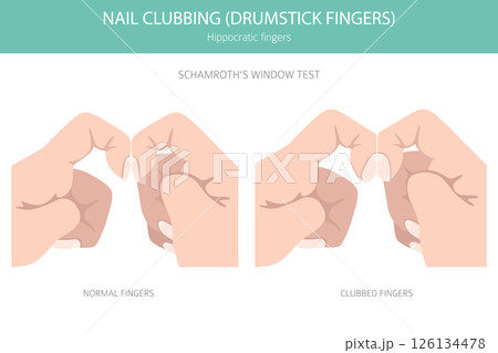 Digital Clubbing Nail Disease - Medical Infographic Vector Illustration 126134478