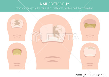 Nail dystrophy. Nail diseases. Medical infographic design 126134480