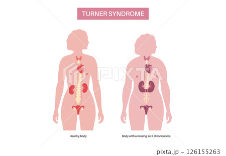 Turner syndrome poster 126155263
