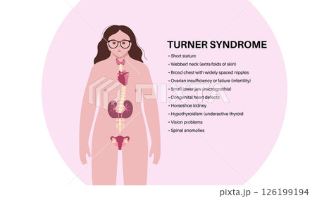 Turner syndrome poster 126199194