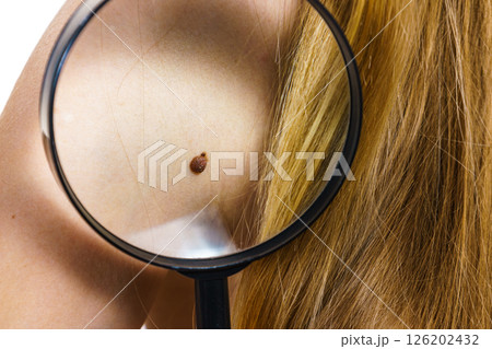 Closeup brown mole on skin. 126202432