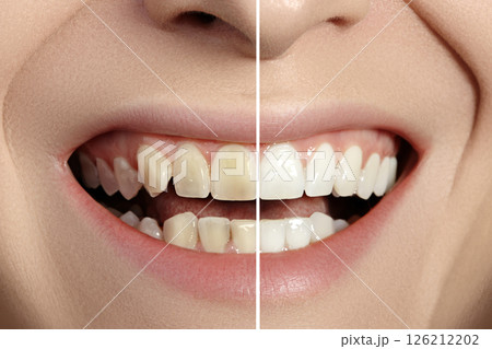 Woman Teeth Before and After Whitening. Perfect Smile with Healthy Teeth. Dental Clinic Patient. Oral Care Dentistry Woman Teeth Before and After Whitening. Perfect Smile with Healthy Teeth. Dental Clinic Patient. Oral Care Dentistry 126212202