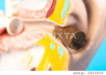 Earwax plug in the ear canal of the ear model, close-up Earwax plug in the ear canal of the ear model, close-up 126233574