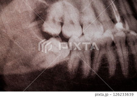Impacted wisdom tooth on the lower jaw x-ray image, close-up 126233639
