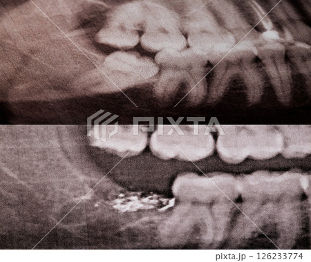 X-ray of the lower wisdom tooth and the removed wisdom tooth. Tooth socket with alveolitis, close-up X-ray of the lower wisdom tooth and the removed wisdom tooth. Tooth socket with alveolitis, close-up 126233774