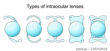 Types of intraocular lenses in Cataract surgery. 126252614