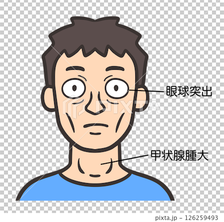 一名患有格雷夫茲病的男子的臉部 一名患有格雷夫茲病的男子的臉部 126259493