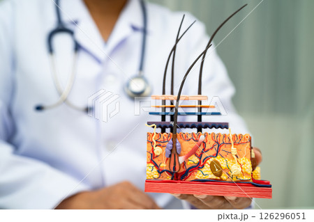Hair transplant, Asian dermatologist doctor holding skin structure anatomy model for treatment in hospital. Hair transplant, Asian dermatologist doctor holding skin structure anatomy model for treatment in hospital. 126296051