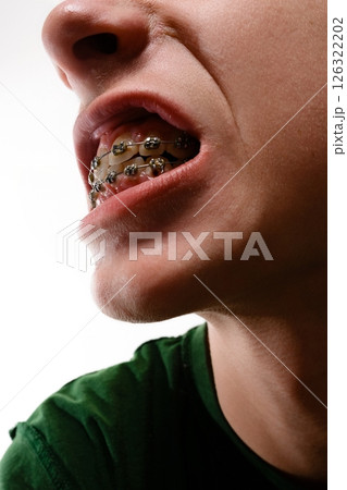 Close-up of a person's mouth with metal braces. 126322202