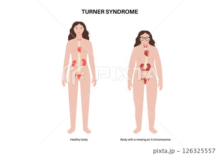 Turner syndrome poster 126325557
