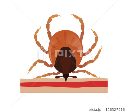 Encephalitis tick biting human skin, mite Encephalitis tick biting human skin, mite 126327916