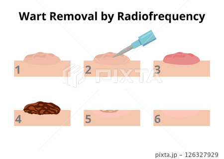 Wart removal by radiofrequency surgery 126327929