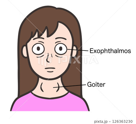 バセドウ病の症状が出ている女性の顔 バセドウ病の症状が出ている女性の顔 126363230