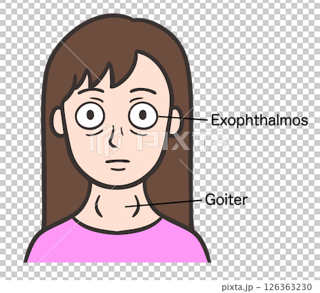 バセドウ病の症状が出ている女性の顔 バセドウ病の症状が出ている女性の顔 126363230