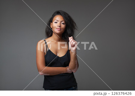 Young woman with vitiligo poses confidently in 126376426