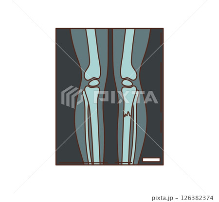 Cartoon groovy xray scan showing human leg bones, with a visible fracture on one side. medicine and human body medical vector icon represents radiology, bone health, injury diagnosis, and healthcare 126382374