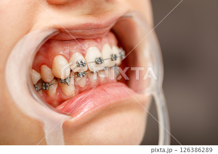 Close-up of dental braces on teeth with mouth opener Close-up of dental braces on teeth with mouth opener 126386289