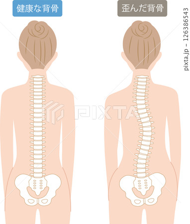 歪んだ背骨と健康な背骨　女性の後ろ姿 126386543