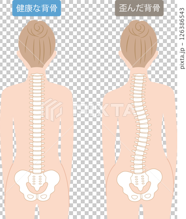 歪んだ背骨と健康な背骨　女性の後ろ姿 126386543