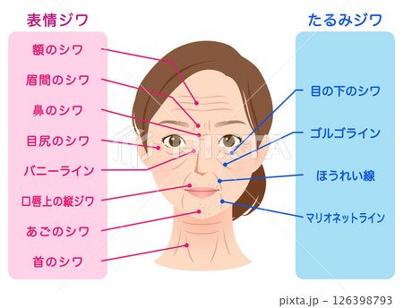 シワの種類　女性の顔　美容 126398793