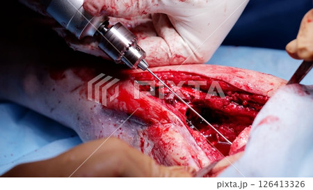 Medical professionals are meticulously operating on a patient's leg, employing surgical instruments with precision and care during a critical procedure 126413326