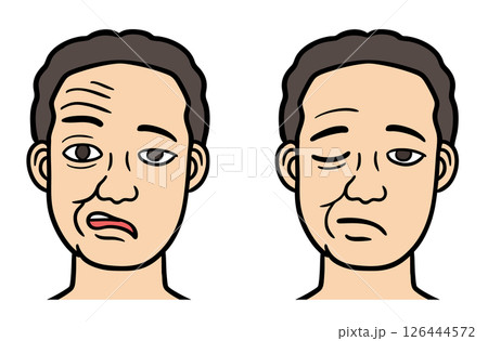 顔面神経麻痺の男性の顔 126444572