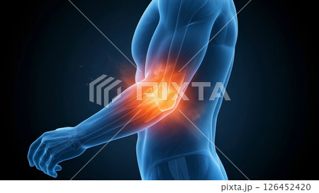 左向き男性の、肘の痛みや筋肉の緊張を表現した医学的イラスト。人体の筋肉構造を示し、炎症や負傷を強調 126452420