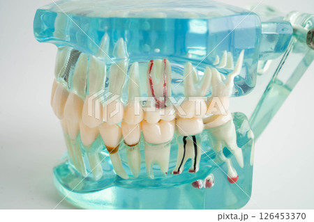 Dental implant, artificial tooth roots into jaw, root canal of dental treatment, gum disease, teeth model for dentist studying about dentistry. Dental implant, artificial tooth roots into jaw, root canal of dental treatment, gum disease, teeth model for dentist studying about dentistry. 126453370