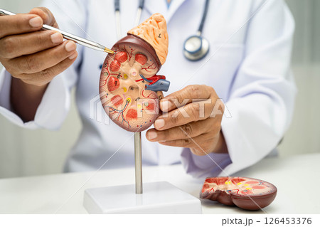 Chronic kidney disease, doctor with model for treatment urinary system, urology, Estimated glomerular filtration rate eGFR. Chronic kidney disease, doctor with model for treatment urinary system, urology, Estimated glomerular filtration rate eGFR. 126453376