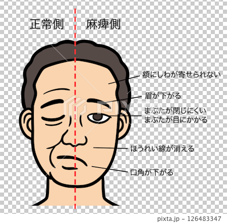 A man with facial paralysis closing his eyes, comparing the normal side with the paralyzed side 126483347