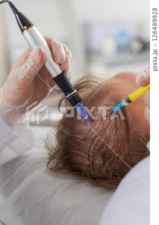 Trichologist doing man hair regeneration procedure dermapen microneedling vitamin exosomes injection 126489928