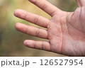 Hand Eczema on man hand with selective focus from being allergic reactions some chemical  oxidant 126527954