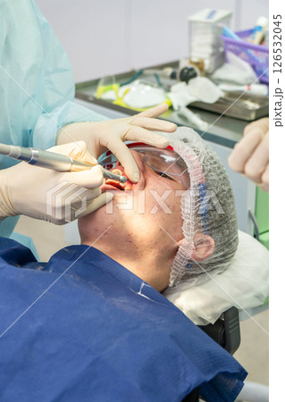 Dental cleaning procedure in a clinic with focus on plaque removal and teeth whiteness 126532045