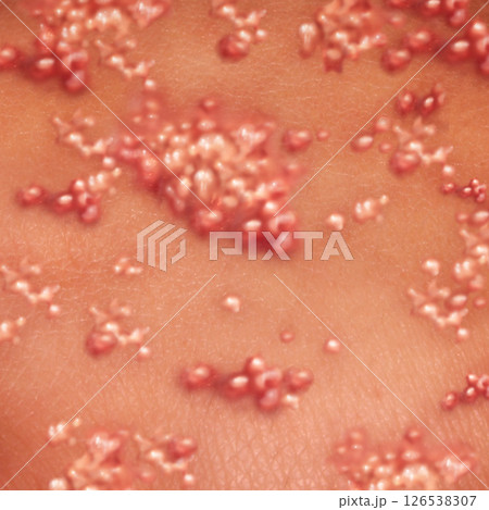 Herpes Virus 126538307